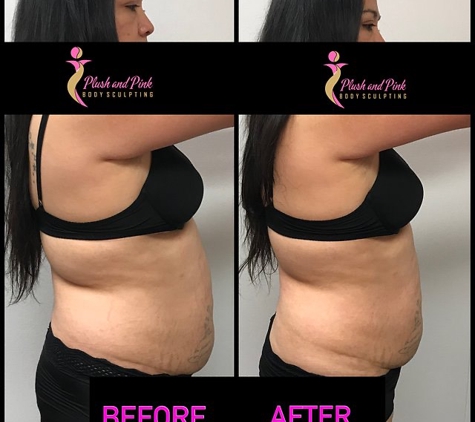 Plush and Pink Body Sculpting - Non-Invasive Lipo - Houston, TX