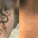 ReversaTatt Tattoo Removal - Tattoo Removal