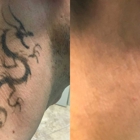 TakeTatt Tattoo Removal