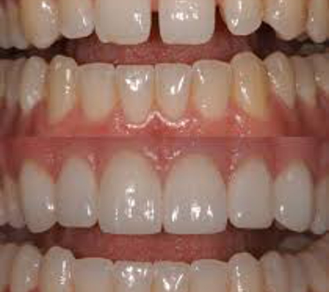 Middlebury Dentist - Middlebury, CT. Veneers and Crowns.