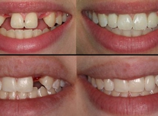 MIRACLE SMILE DENTISTRY, Cosmetic - Implants and Invisalign