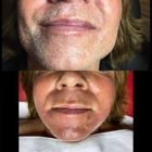 Electrolysis Center Laser Hair Removal