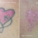 Inkfree, MD Laser Clinic - Skin Care