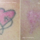 Inkfree, MD Laser Clinic
