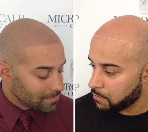 Micro Scalp Clinic - Boston, MA