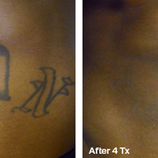 Laser Tattoo Removal by Tatt Cemetery - Fort Myers, FL