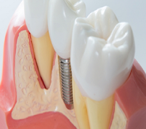Yass Valley Dental - Murrumbateman, NSW. Implants – Surgery To Crown Completed In House