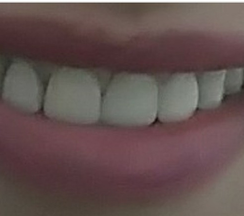 Michael M Meliza, DDS - Houston, TX. first set of crowns. Had to many gaps, kept getting food caught between  my teeth. Never had this issue before.