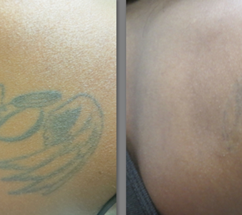 Clear Out Ink Laser Tattoo Removal LLC - Henderson, NV