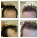 Natural Transplant, Hair Restoration Clinic MIAMI - Medical Clinics