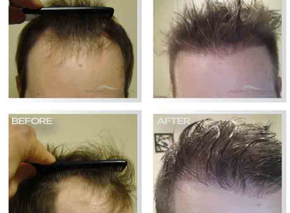 Natural Transplant, Hair Restoration Clinic MIAMI - Miami, FL