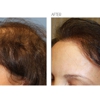 Beverly Hills Hair Restoration gallery