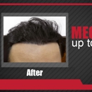 MAXIM Hair Restoration - Hair Replacement