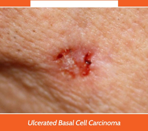Port Macquarie Skin Cancer Clinic - Port Macquarie, NSW. Ulcerated Basal Cell Carcinoma