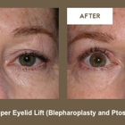 Klapper Eyelid & Facial