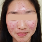 Proderma Acne Clinic