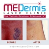 MEDermis Tattoo Removal gallery