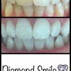 Diamond Smile Whitening