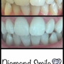 Diamond Smile Whitening