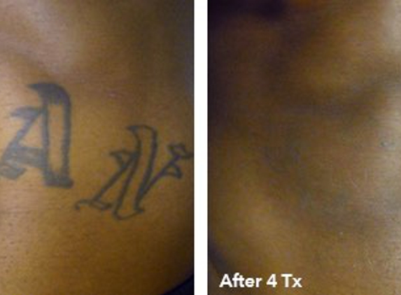Eraser Clinic Laser Tattoo Removal - Austin, TX
