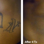 Eraser Clinic Laser Tattoo Removal