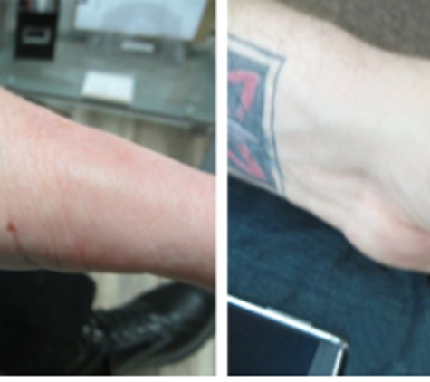 Clear Out Ink Laser Tattoo Removal LLC - Henderson, NV