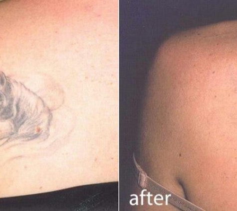 Blank Slate Laser Tattoo Removal - Houston, TX