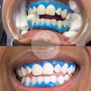 Halo Ali Teeth Whitening - Cosmetic Dentistry