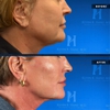 Kevin R. Hanz, MD. Aesthetic Plastic Surgery gallery