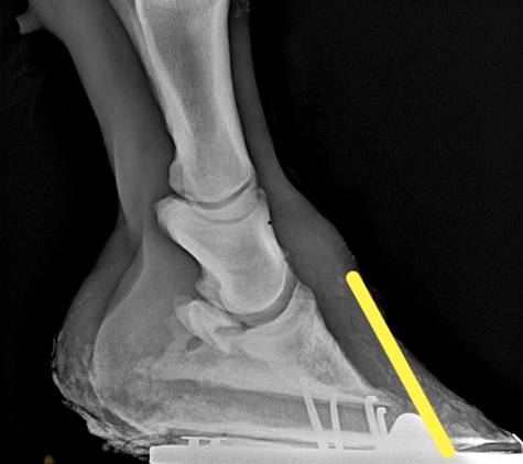 Rennie's Horseshoeing - Billings, MT. Severe Toe distortion with full length toe crack -Radiograph pic 2  of 6