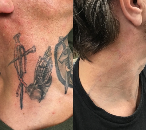 Removery Tattoo Removal & Fading - New York, NY