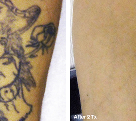 Laser Tattoo Removal by Tatt Cemetery - Fort Myers, FL