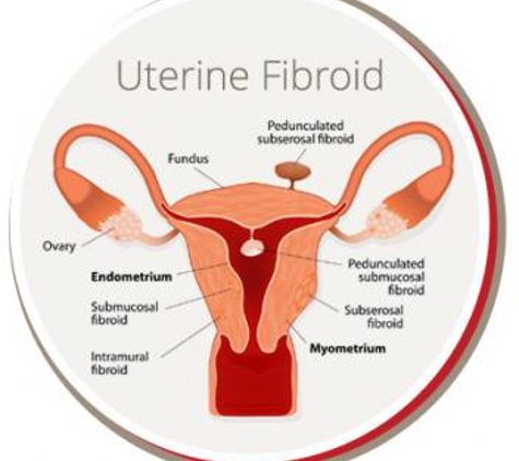 USA Fibroid Centers - Tamarac, FL