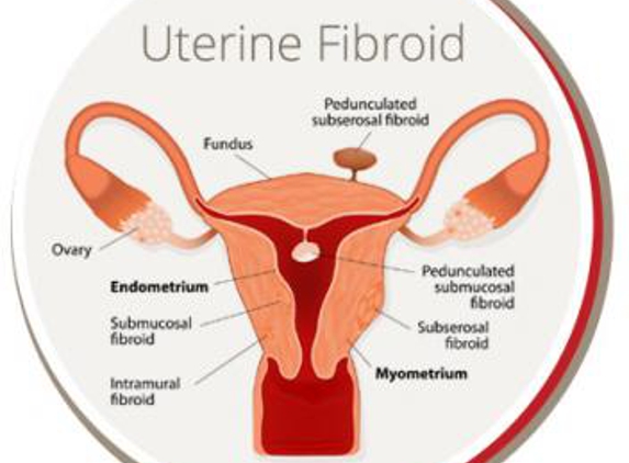 USA Fibroid Centers - Chicago, IL