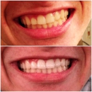 Maui Whitening North Tampa - Teeth Whitening Products & Services