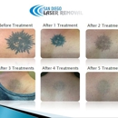 San Diego Laser Removal - Tattoo Removal