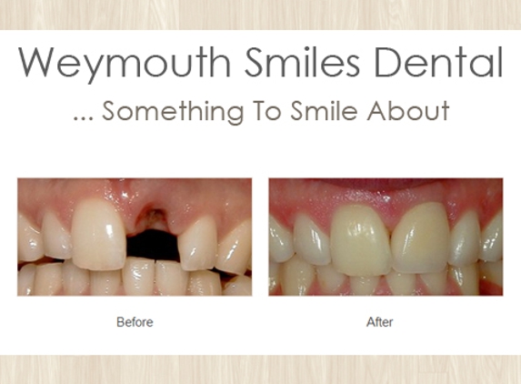 Weymouth Smiles Dental - East Weymouth, MA. Same Day Crowns Dentist East Weymouth, MA