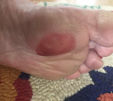 Famous Footwear - Yuma, AZ. Blood blister Caused from insert wearing out in 5 weeks!