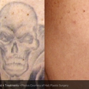 DermaTouch RN - Tattoo Removal