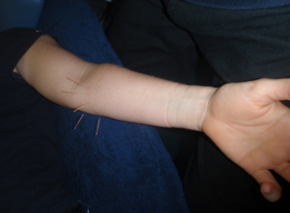 Body And Mind - Mudgeeraba, QLD. Dry Needling Forearm