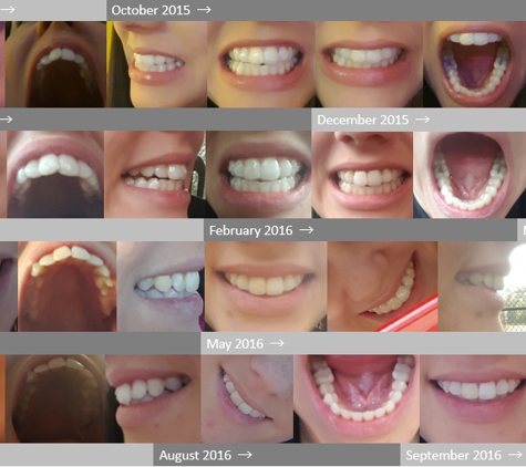 Leiker Orthodontics - Woodlands - Spring, TX. Treatment Process