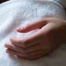 Acupuncture NYC - Acupuncture