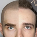 Real Time Results - Hair Replacement