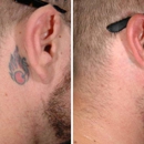 ReversaTatt - Tattoo Removal