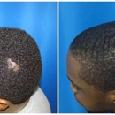Houston Hair Transplant Center - Hair Replacement