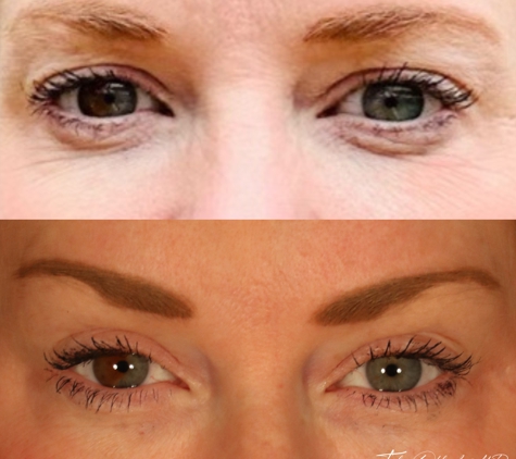 Okland Facial Plastic Surgery - Denver, CO. Brow Lift