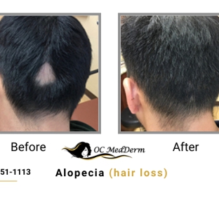 Oc Medderm - Irvine, CA. Alopecia (hair loss)