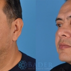 Bader Facial Plastics