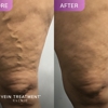 Vein Treatment Clinic | Cibolo - Schertz gallery
