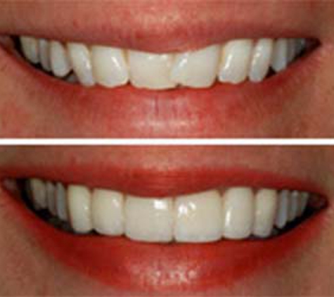 Houston Dental Esthetics - Houston, TX. Veneers at Houston Dental Esthetics